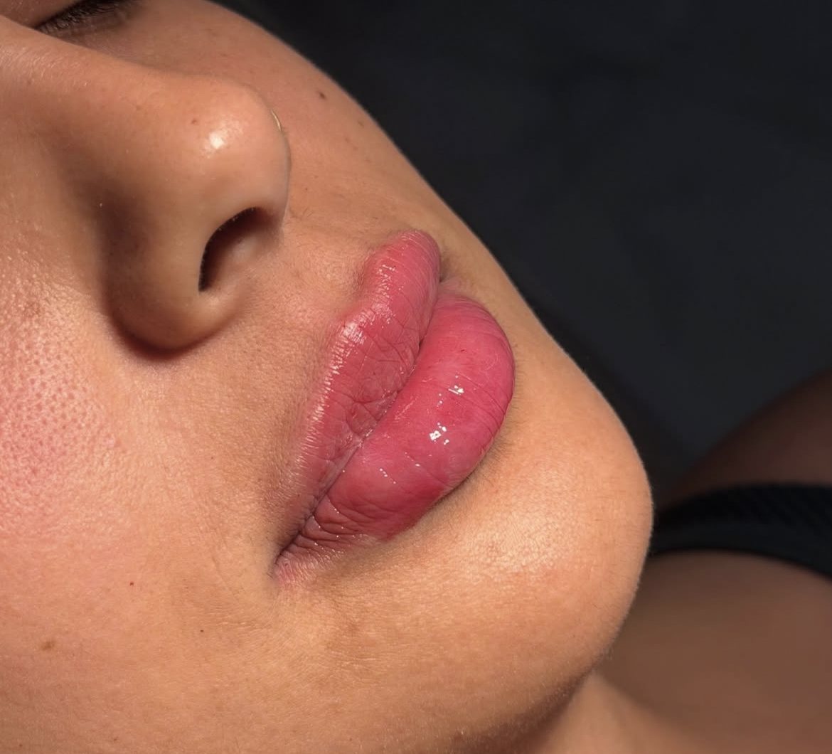 Resultado de preenchimento labial natural