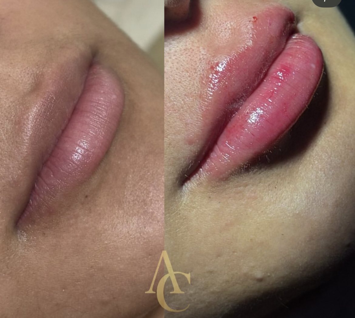 Resultado de preenchimento labial