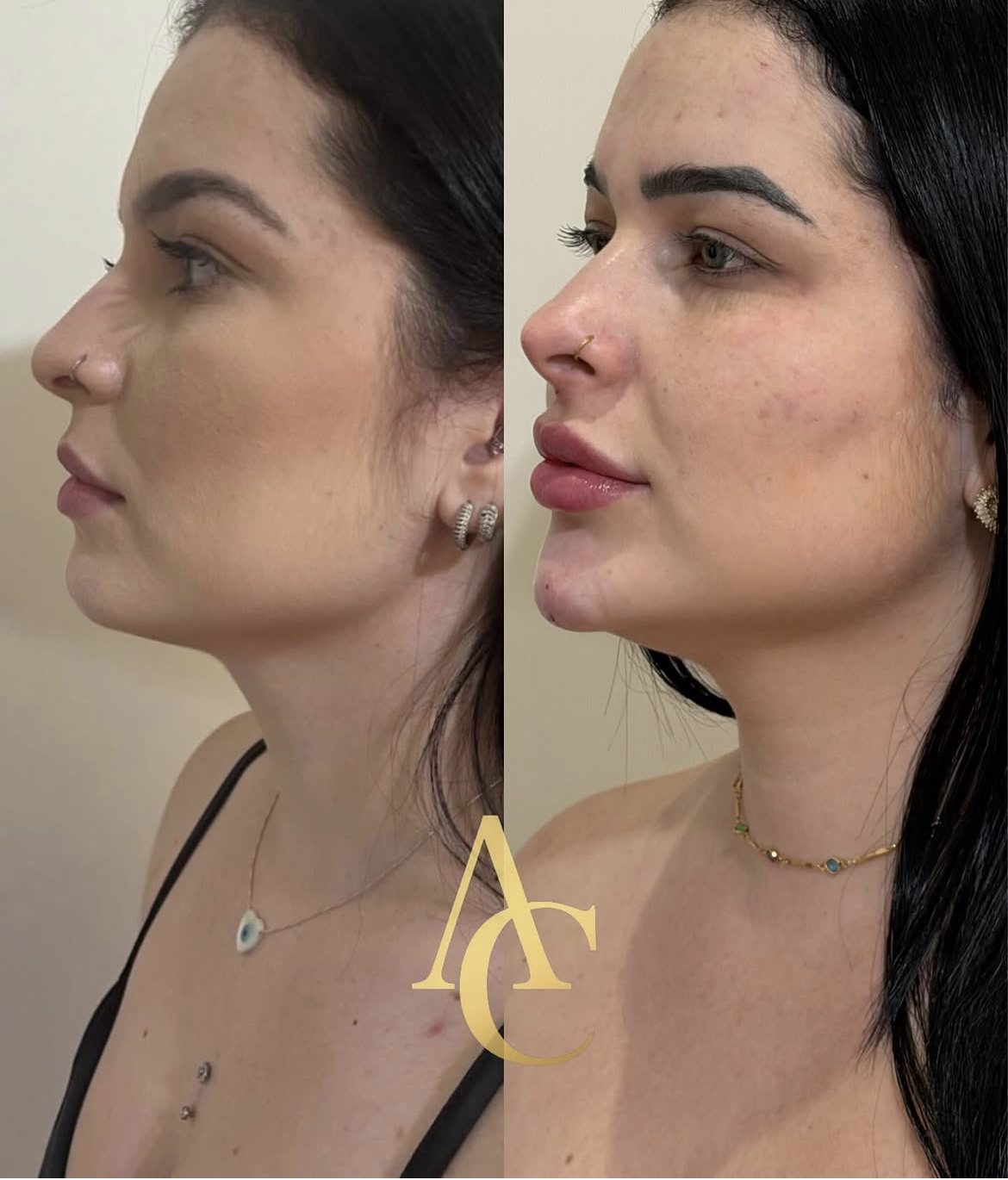 Antes e depois de harmonização facial — contorno e definição