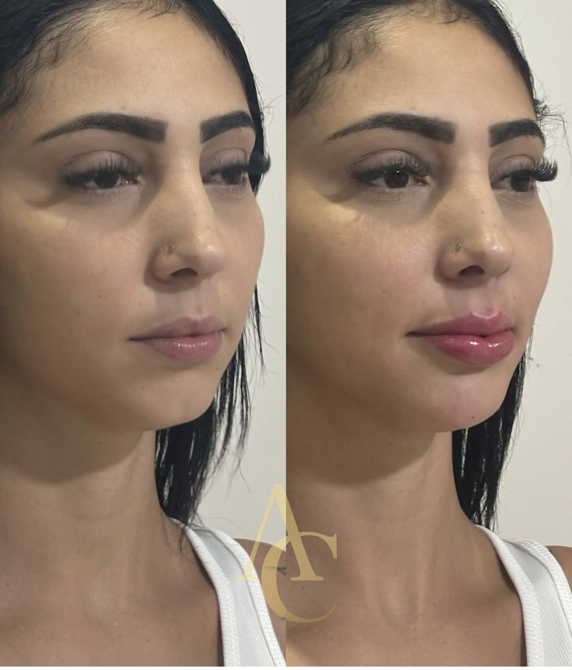Antes e depois de harmonização facial — naturalidade